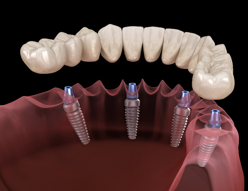 Полное восстановление зубного ряда по технологии All-on-4 в клинике Фэйс Смайл центр