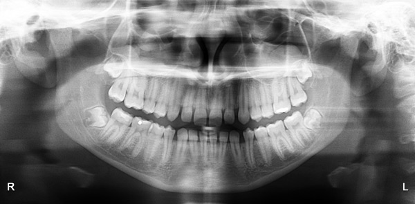 Рентгеновский снимок зубов мудрости 15-ти летнего пациента