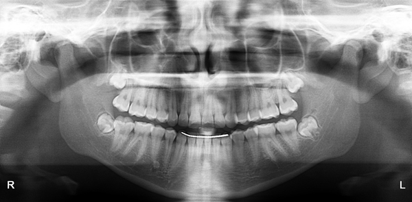 Удаление зубов мудрости после ортодонтического лечения
