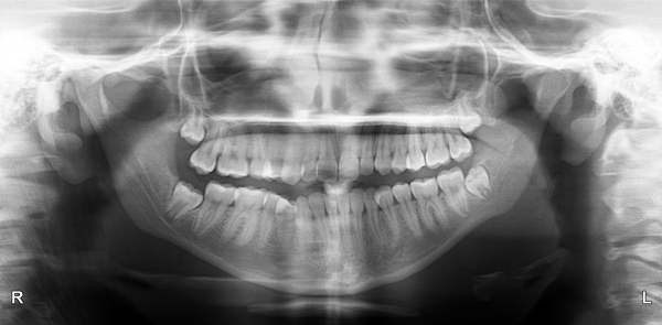 Рентгеновский снимок зубов мудрости 16-ти летнего пациента
