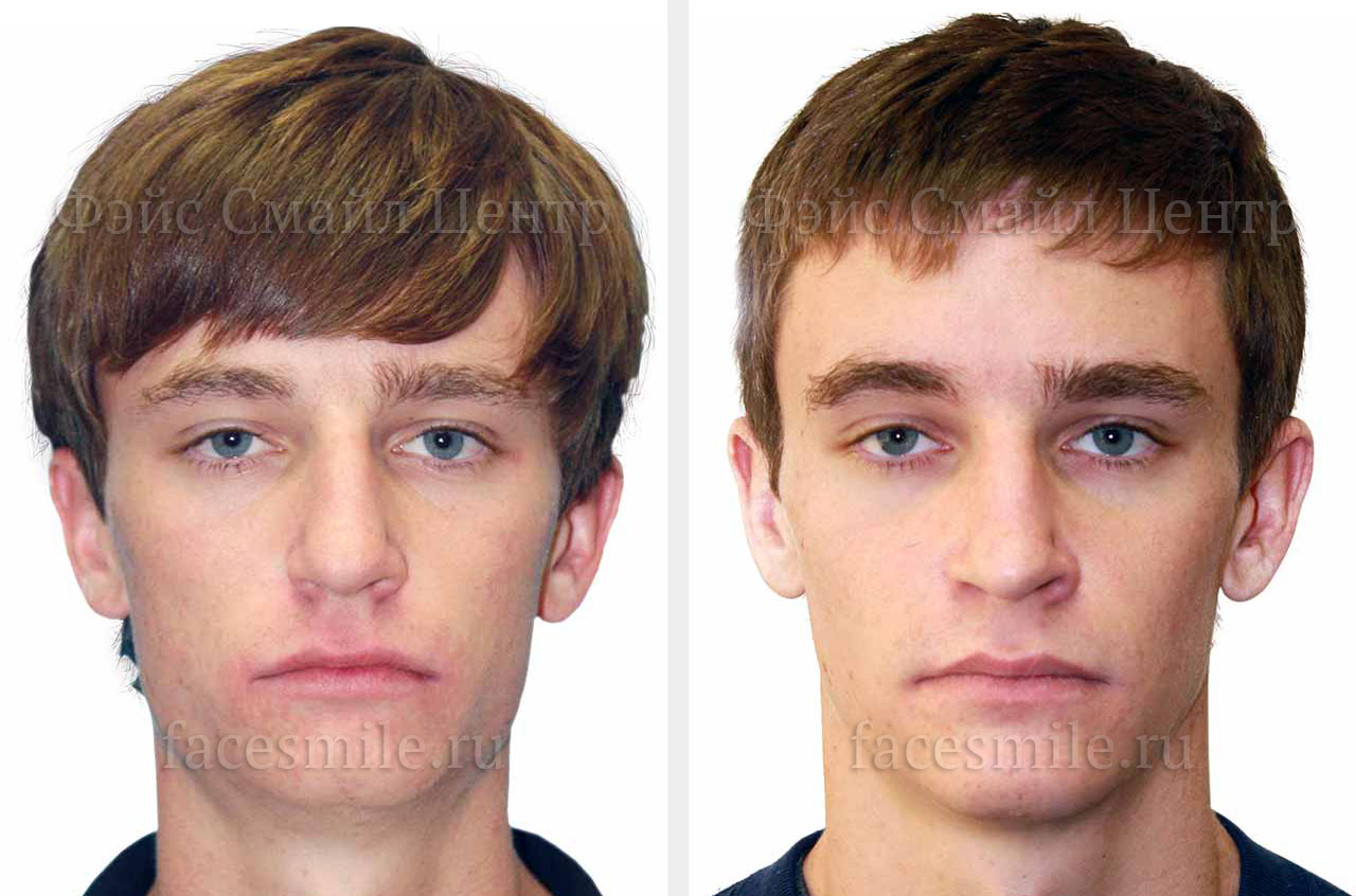Коррекция прикуса и асимметрии лица до и после ортогнатической операции фото пациента в профиль без улыбки