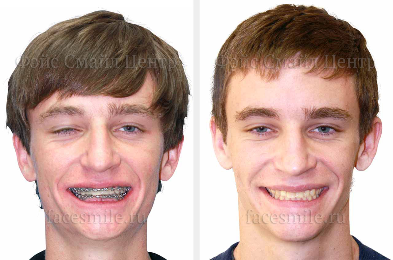 Коррекция прикуса и асимметрии лица до и после ортогнатической операции фото пациента в анфас с улыбкой
