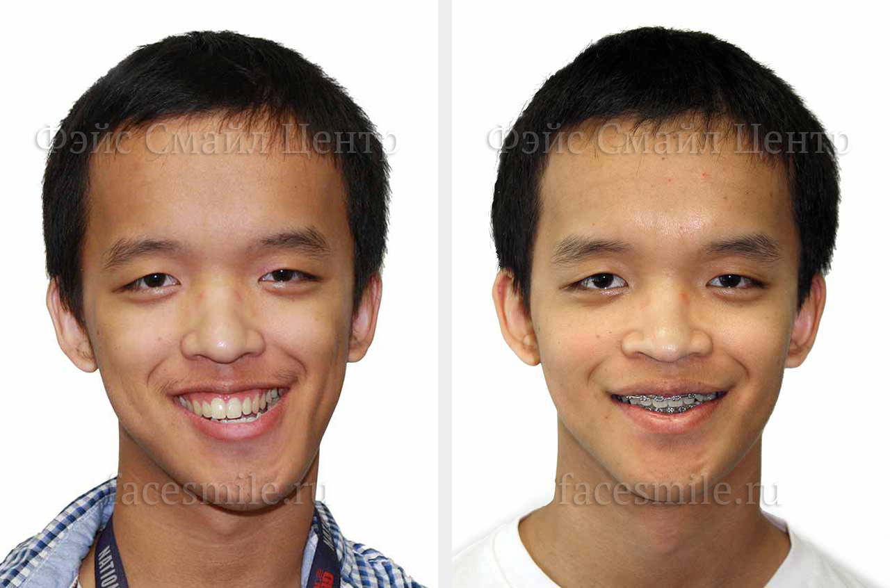Коррекция лицевой асимметрии пациента до и после ортогнатической операции в анфас с улыбкой
