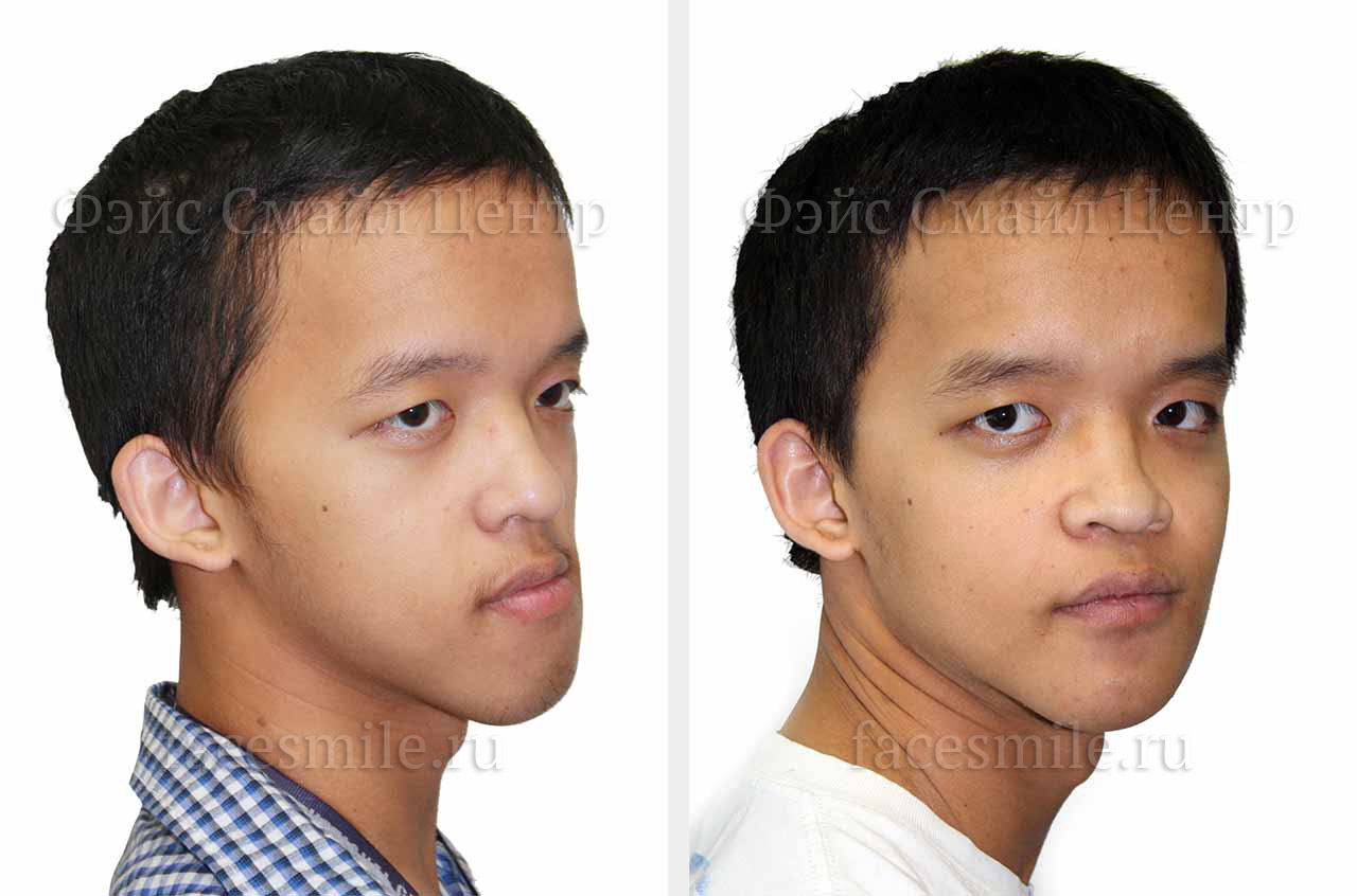 Коррекция лицевой асимметрии пациента до и после ортогнатической операции в профиль без улыбки