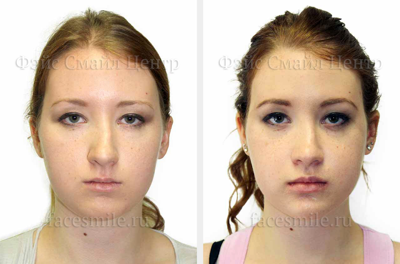 Исправление прикуса, увеличение дыхательных путей, фото пациента до и после ортогнатической операции в профиль без улыбки