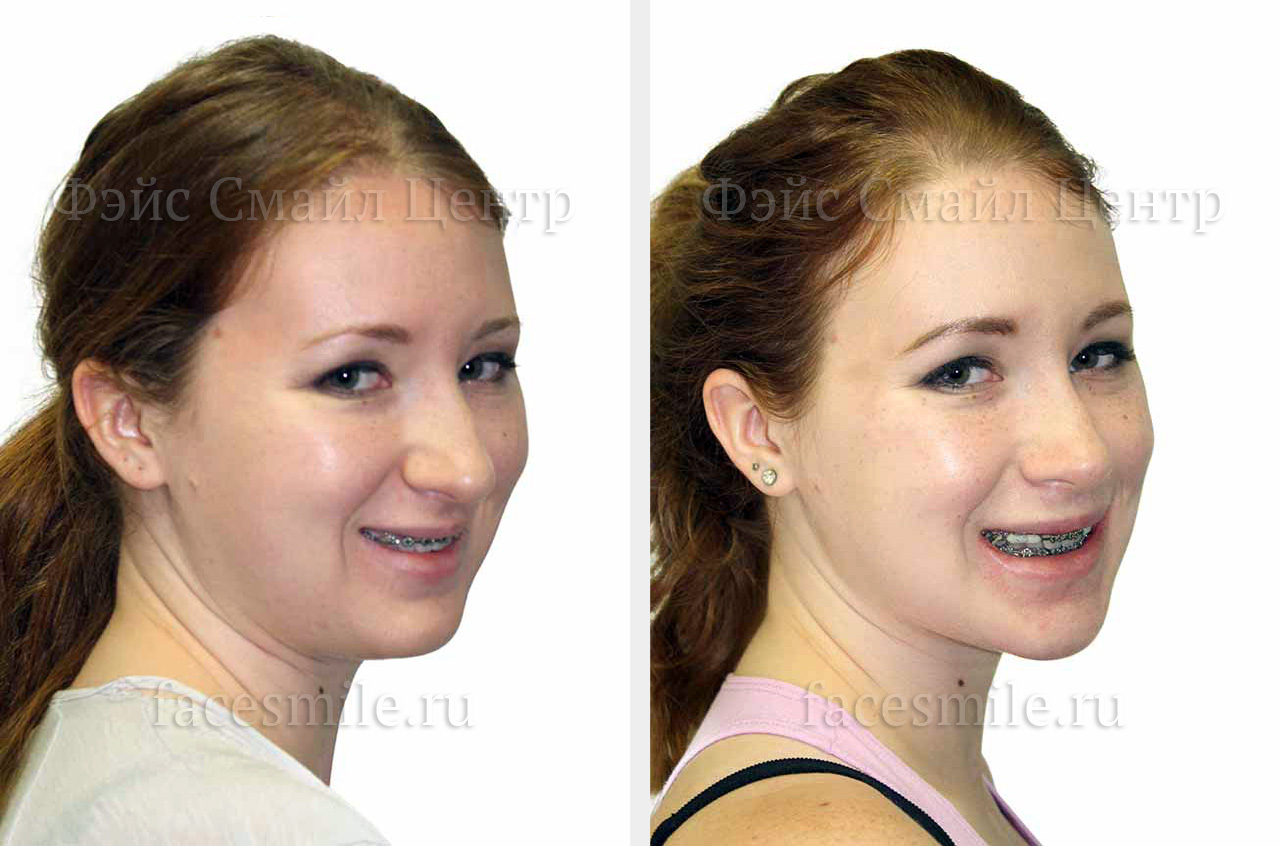 Исправление прикуса, увеличение дыхательных путей, фото пациента до и после ортогнатической операции в три-четверти оборота лица с улыбкой