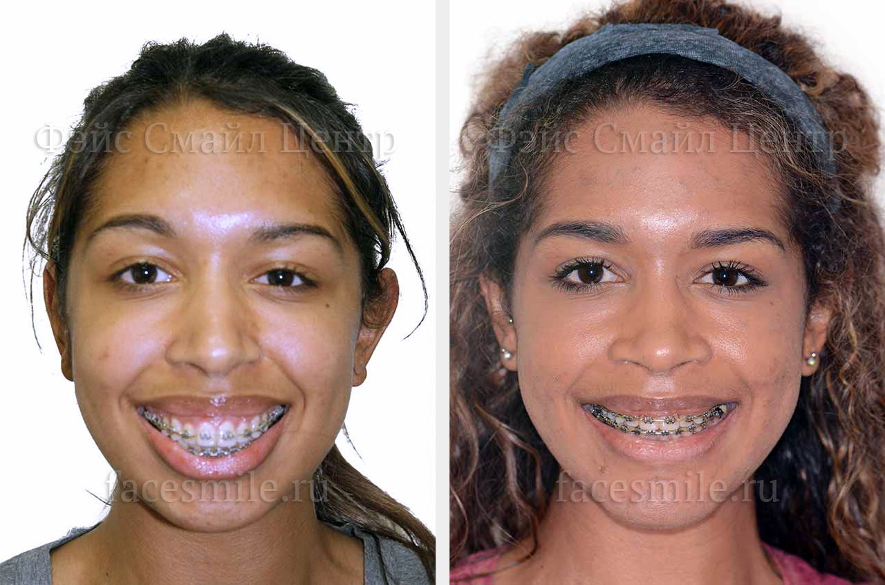 Реконструкция лицевого скелета до и после ортогнатической операции фото пациента в профиль без улыбки губы вместе