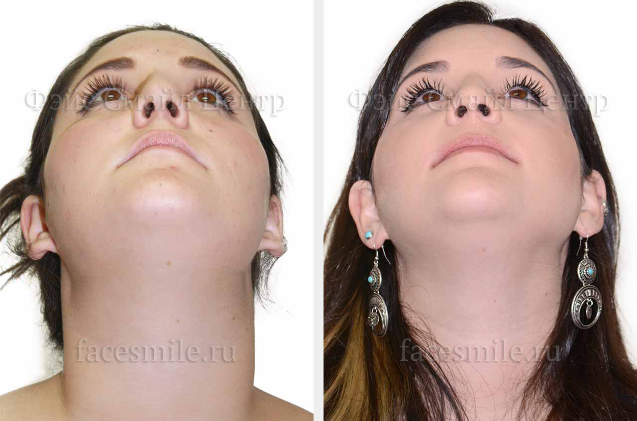 Исправление неправильного прикуса и коррекция лицевой асимметрии до и после операции в профиль без улыбки