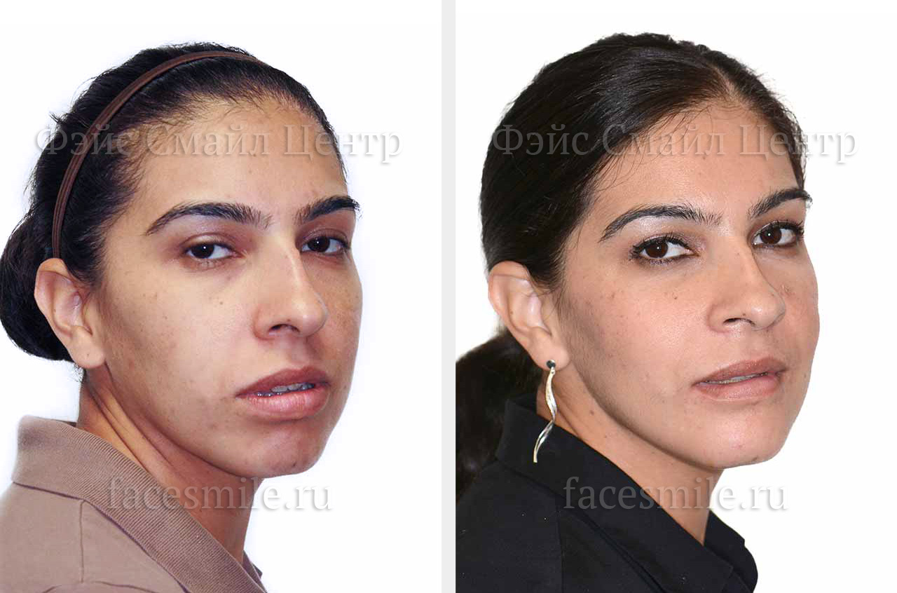 Коррекция прикуса и лицевой ассиметрии фото пациентки до и после ортогнатической операции в три-четверти оборота лица без улыбки