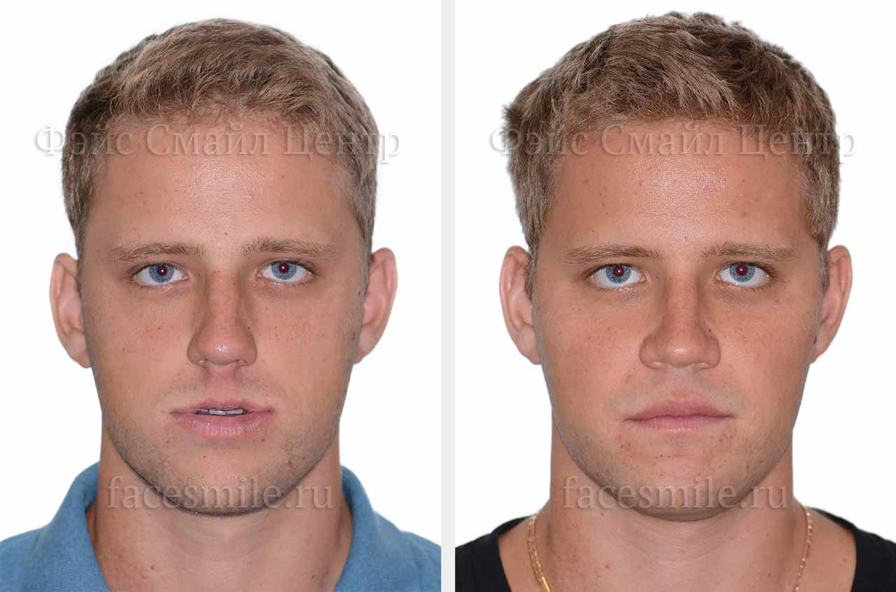 Фото пациента до и после ортогнатической операции в профиль без улыбки