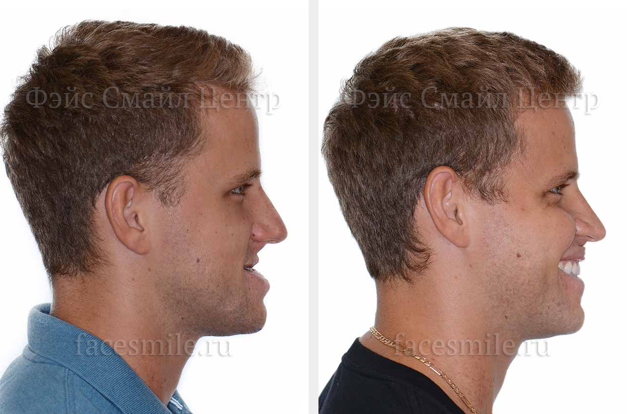 Фото пациента до и после ортогнатической операции в профиль с улыбкой