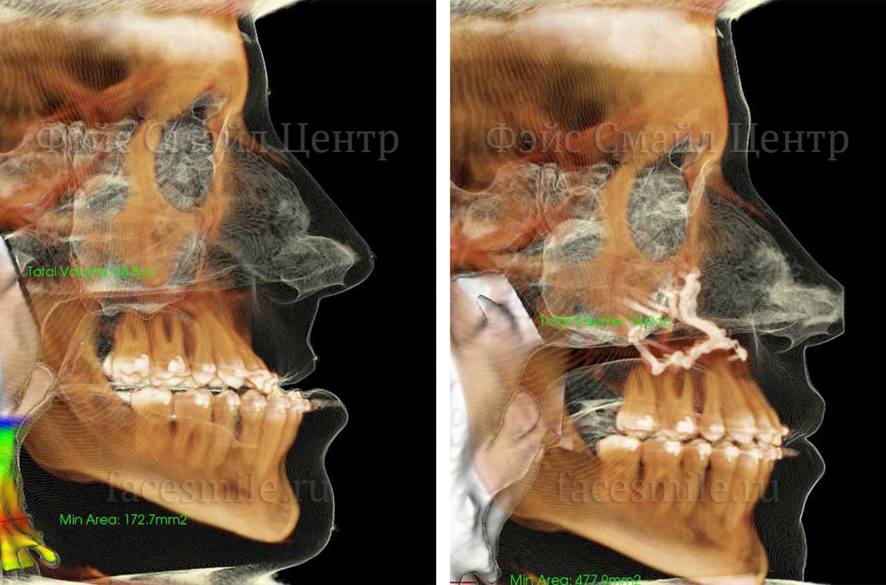 Компьютерная томограмма пациента до и после ортогнатической хирургии