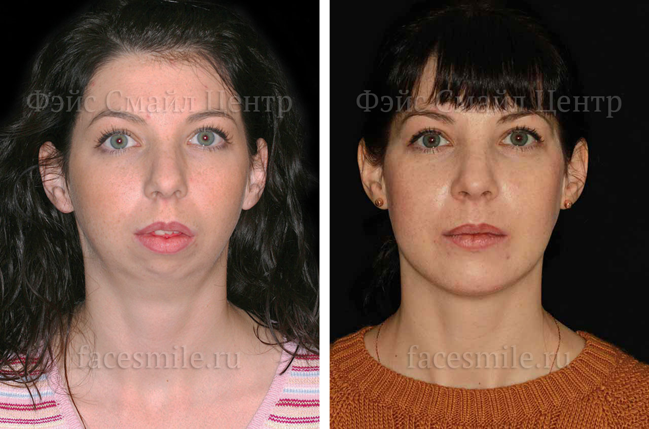 Corrective jaw surgery and bite correction profile view no smile
