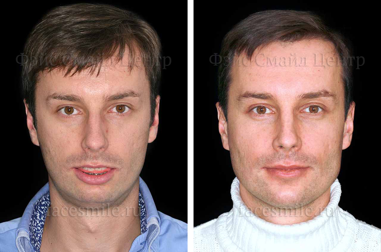 Коррекция прикуса за счет остеотомии при ортогнатической операции фото пациента до и после в анфас без улыбки