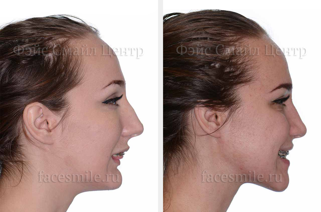 Ортогнатическая операция, фото До и После в анфас, губы расслаблены