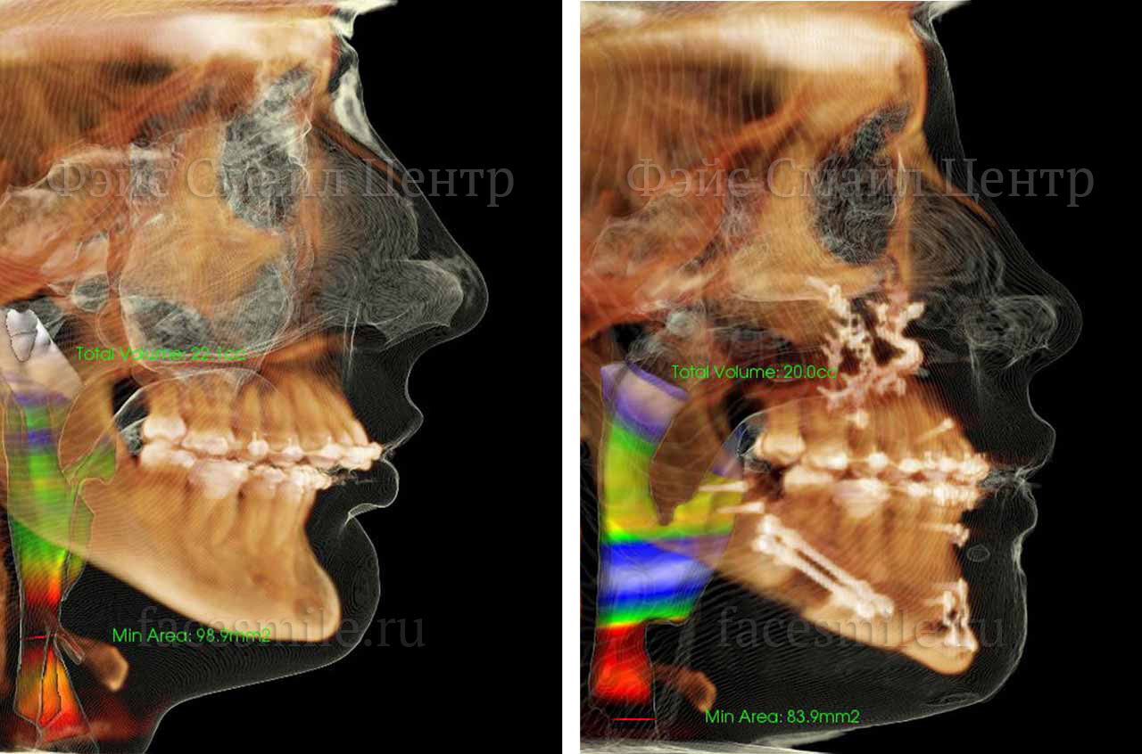 Компьютерная томограмма до и после ортогнатической операции