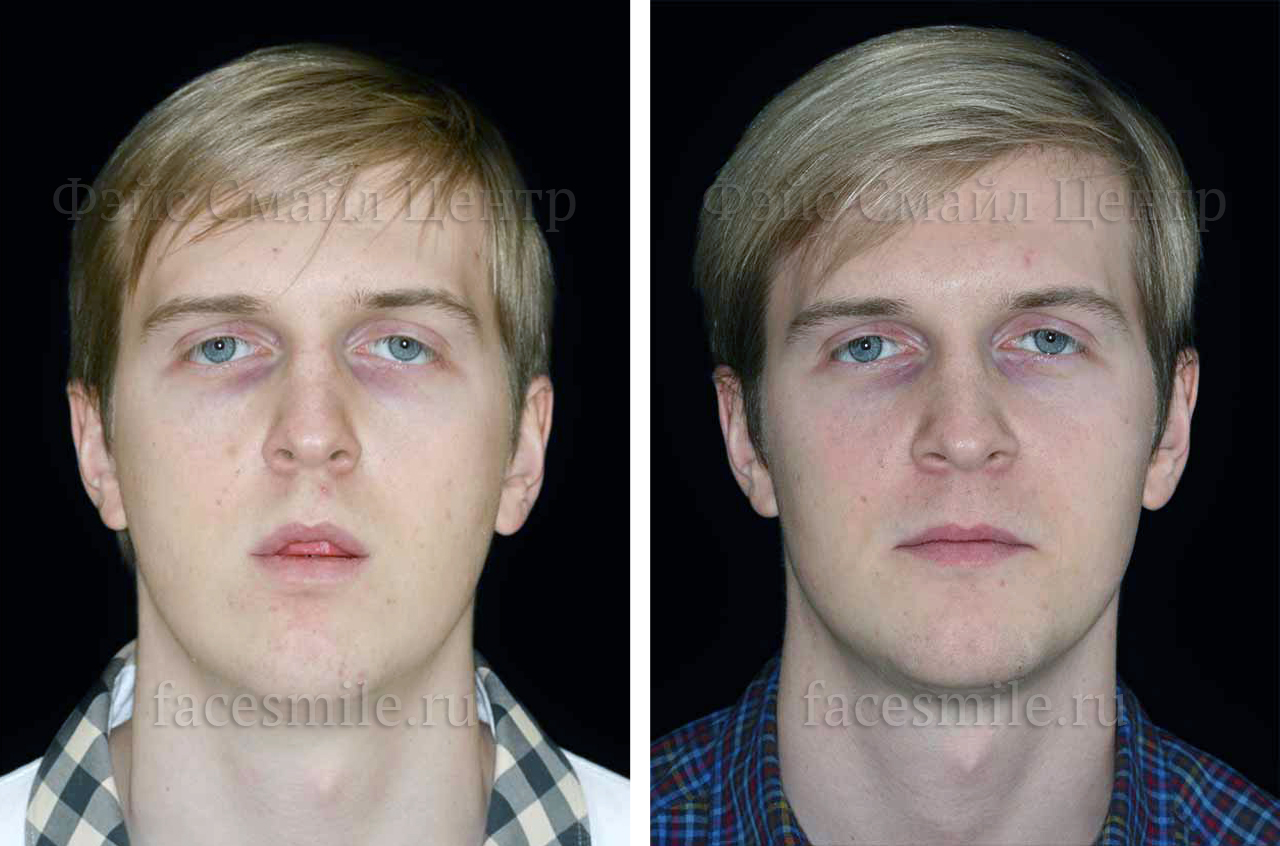 Остеотомия верхней и нижней челюсти, фронтальное фото До и После, губы расслаблены