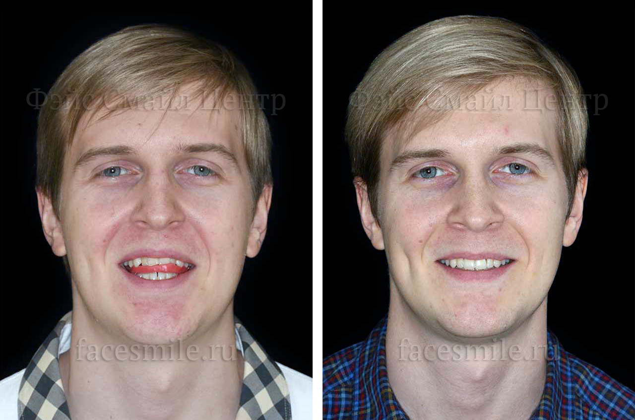 Остеотомия верхней и нижней челюсти, фото До и После в три четверти оборота лица, губы расслаблены