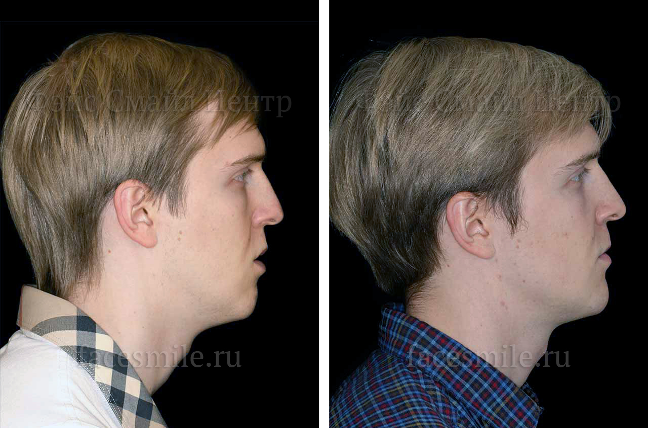 Остеотомия верхней и нижней челюсти, фото До и После в профиль, губы расслаблены