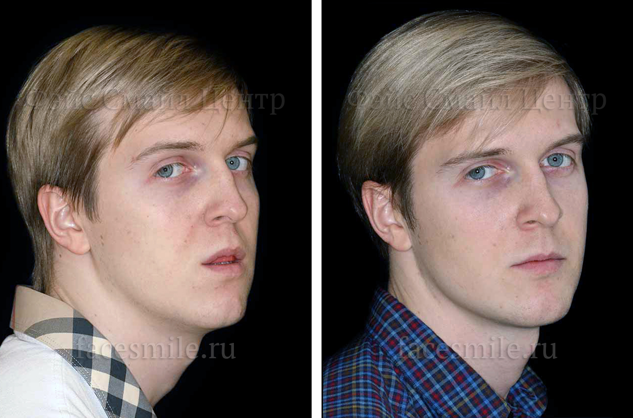 Остеотомия верхней и нижней челюсти, фронтальное фото До и После с улыбкой