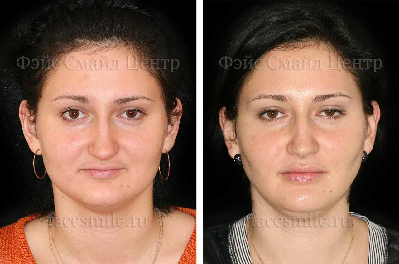 Ортогнатическое хирургическое вмешательство, фронтальное фото До и После, губы расслаблены