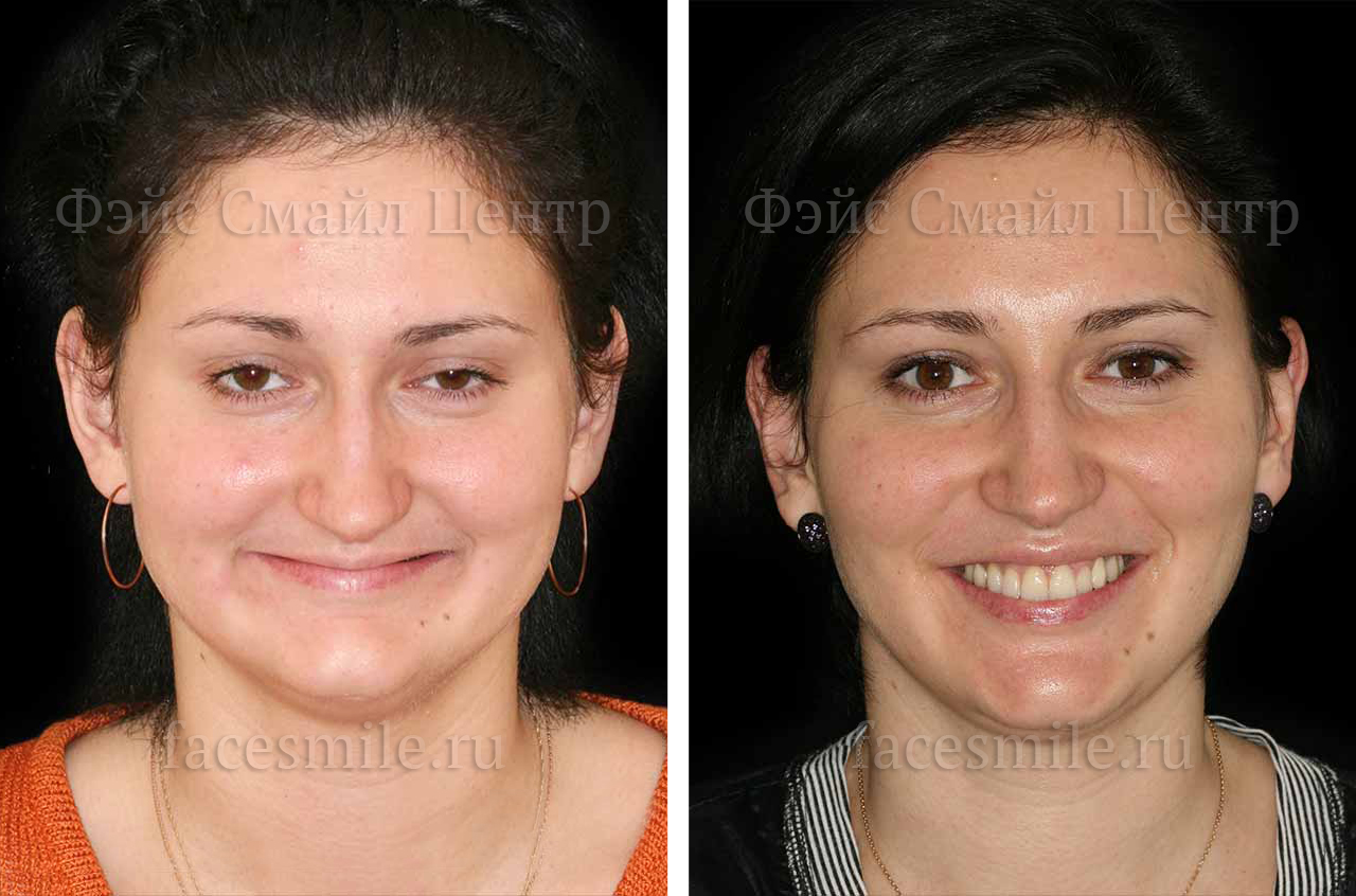 Ортогнатическое хирургическое вмешательство, фронтальное фото До и После с улыбкой