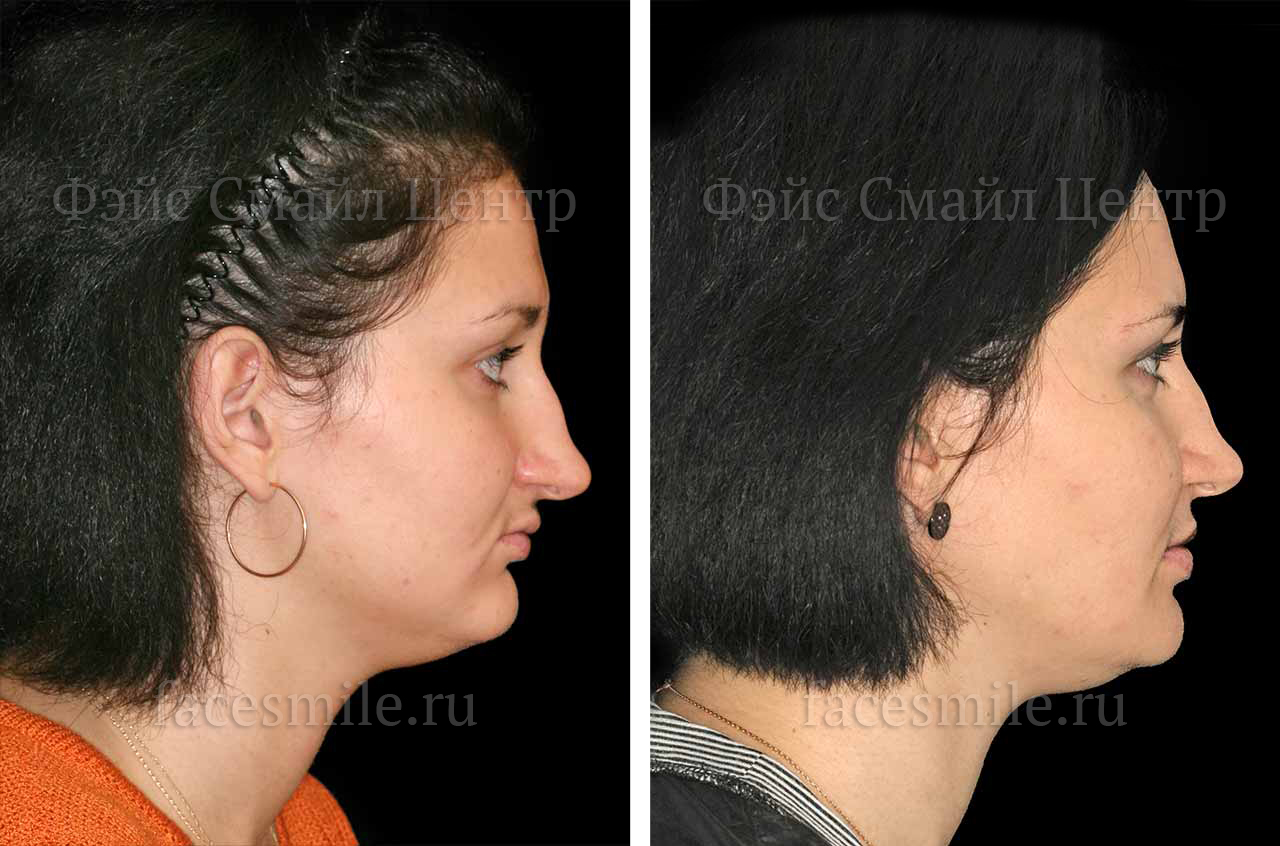 Ортогнатическое хирургическое вмешательство, фото пациента До и После в профиль губы вместе
