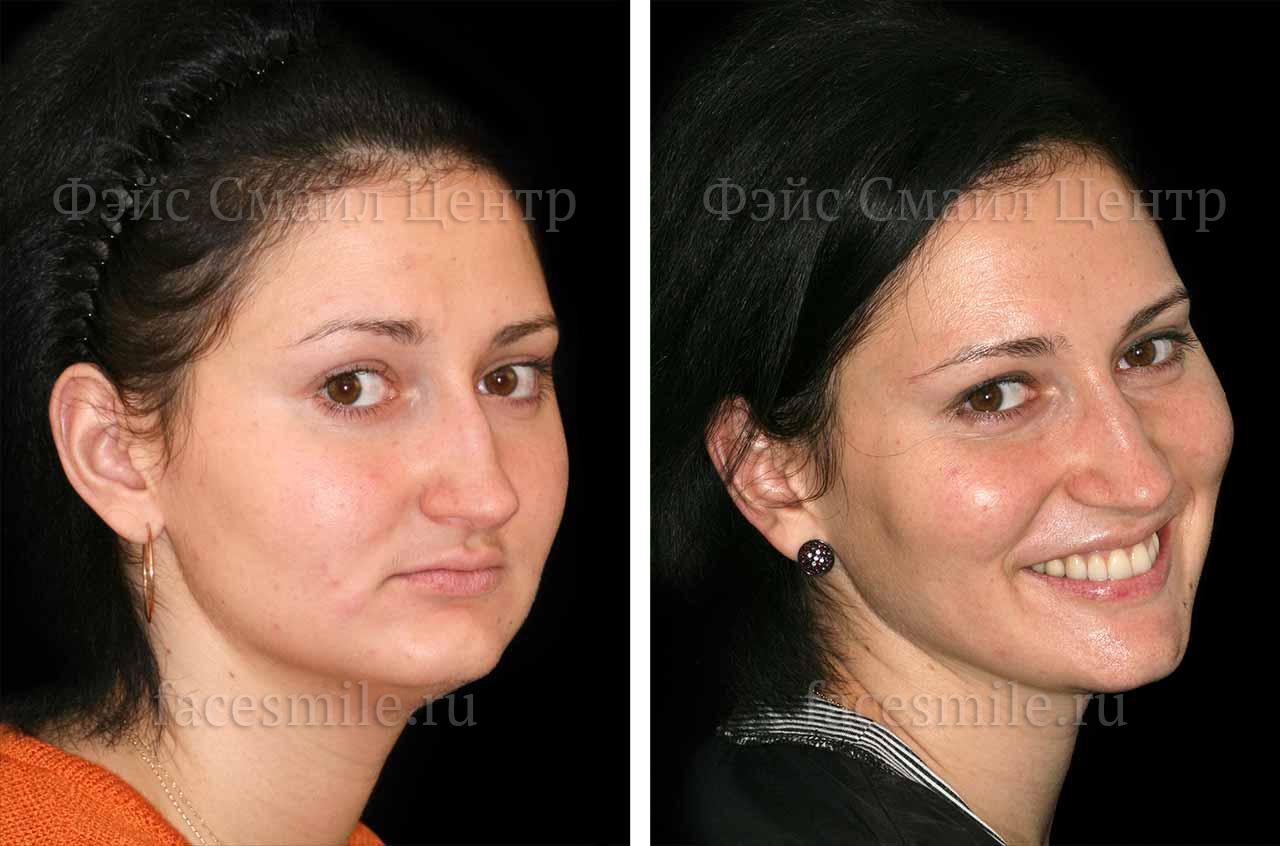 Ортогнатическое хирургическое вмешательство, фото До и После в три четверти оборота лица с улыбкой