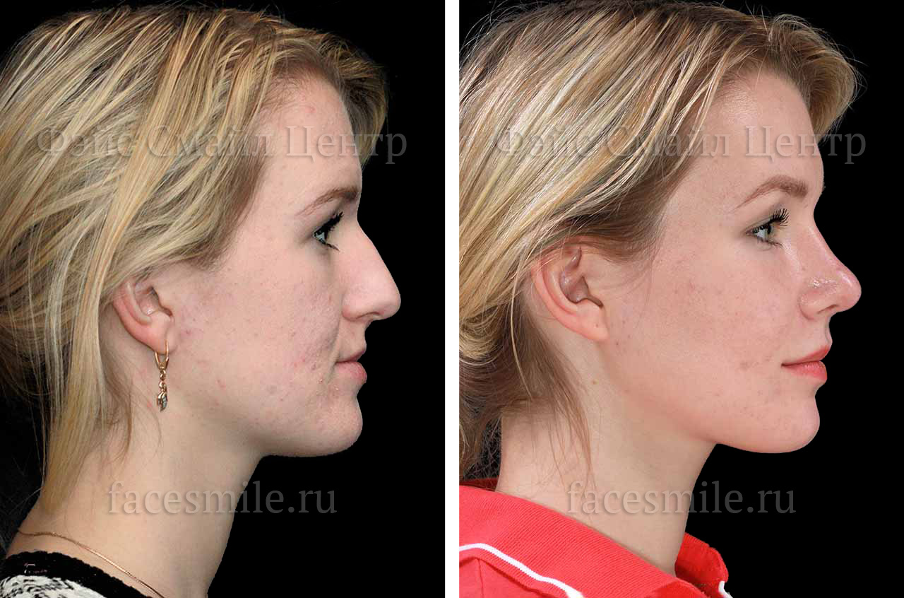 Контурирование тела нижней челюсти, фото пациента До и После в три четверти оборота без улубки