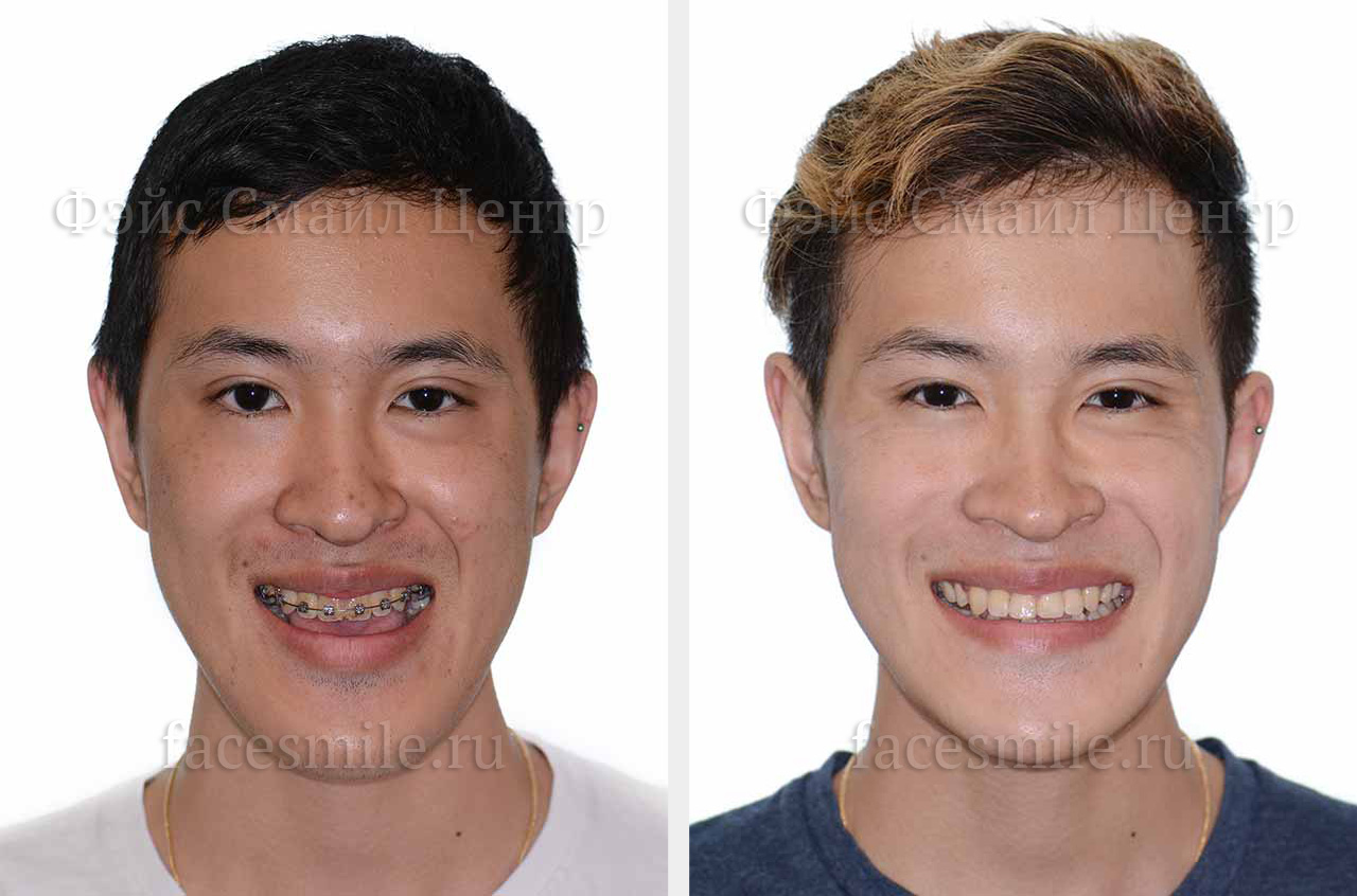 Коррекция открытого прикуса, фронтальное фото До и После без улыбки