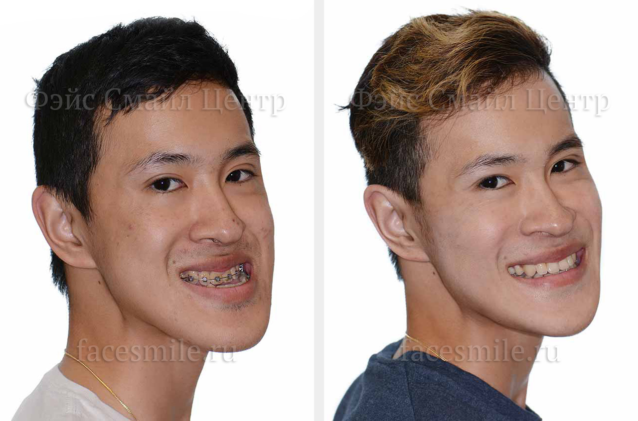 Коррекция открытого прикуса, фото До и После в три четверти оборота лица с улыбкой