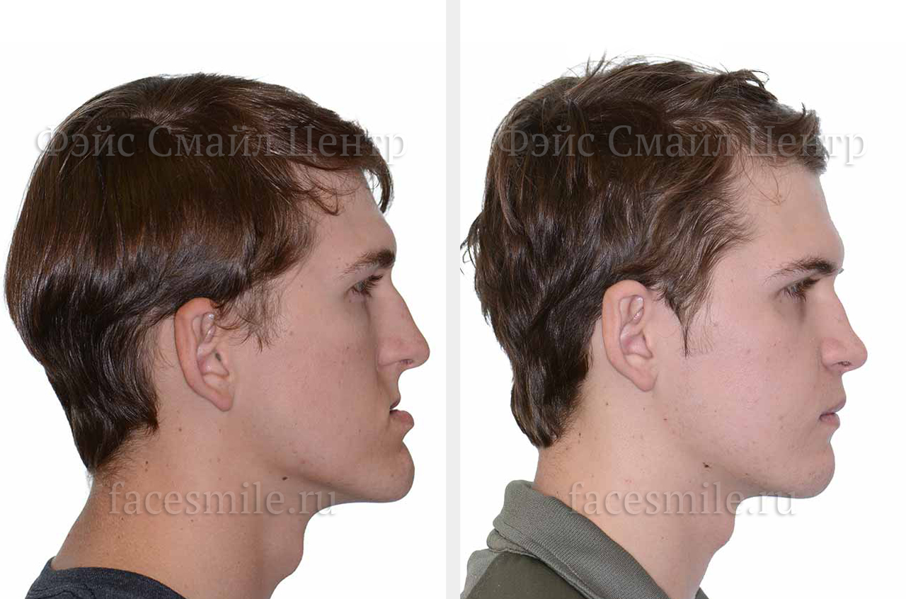 Коррекция лицевого скелета, фото пациента в три-четверти оборота До и После без улыбки