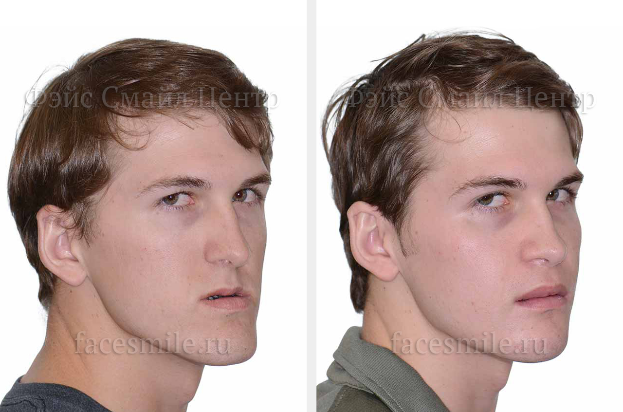 Коррекция лицевого скелета, фронтальное фото До и После без улыбки