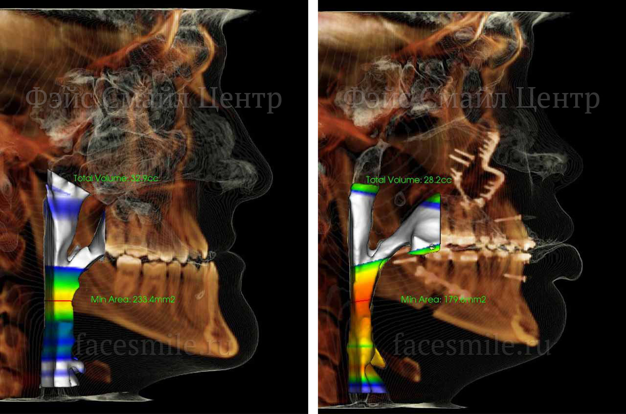 Прикус пациента до и после ортогнатической операции проведенной в клинике доктора Александра Антипова в Калифорнии, США