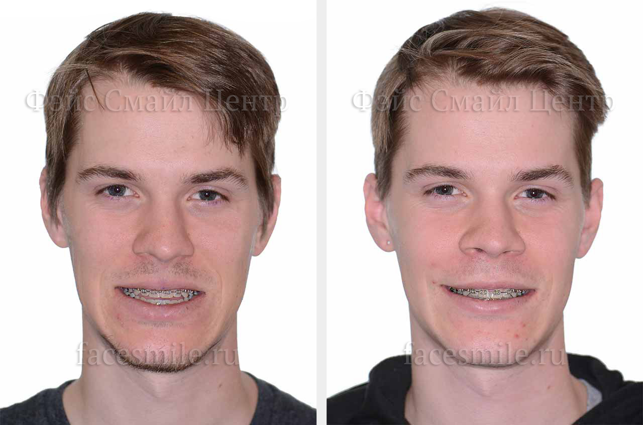 Коррекция лицевого скелета, фронтальное фото До и После с улыбкой