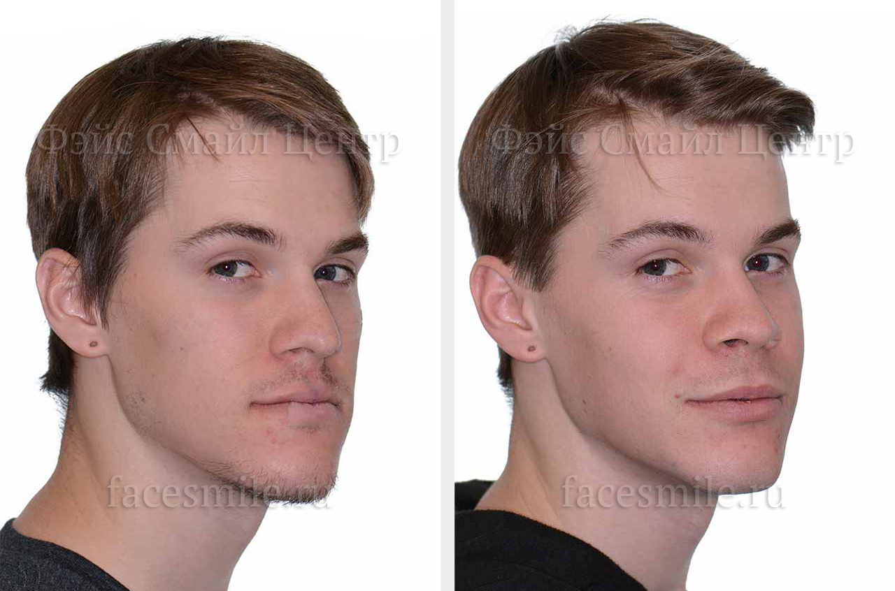 Коррекция лицевого скелета, фронтальное фото До и После без улыбки