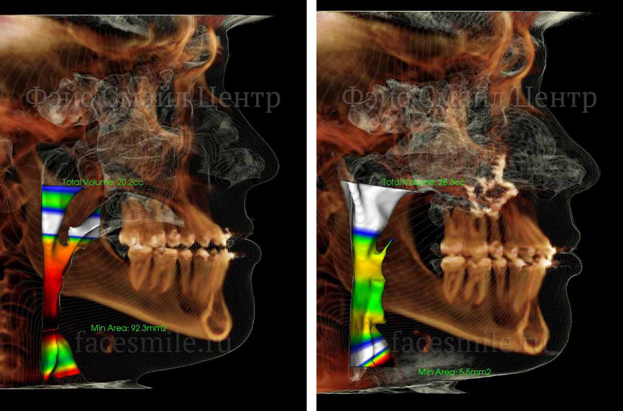 Прикус пациента до и после ортогнатической операции проведенной в клинике доктора Александра Антипова в Калифорнии, США