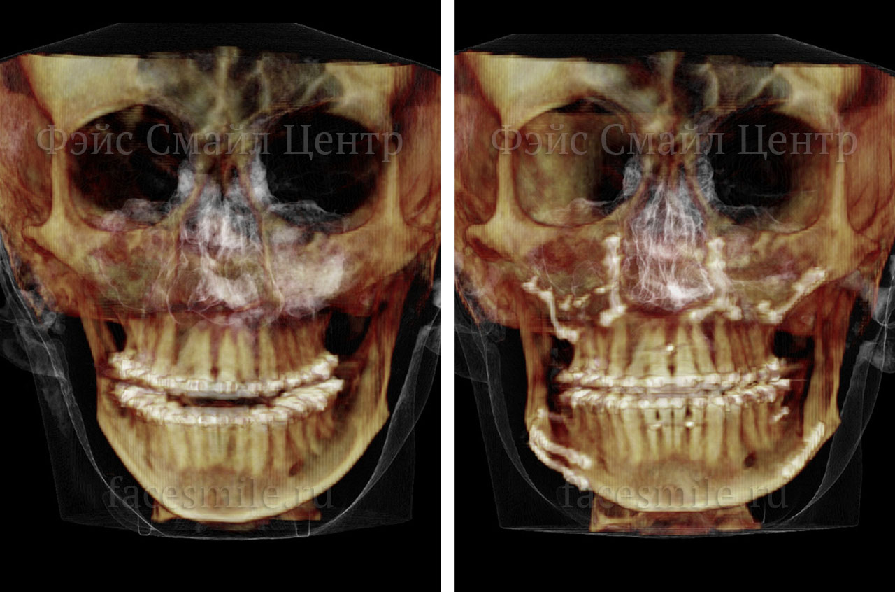 Коррекция асимметрии лица, фото пациента До и После в профиль