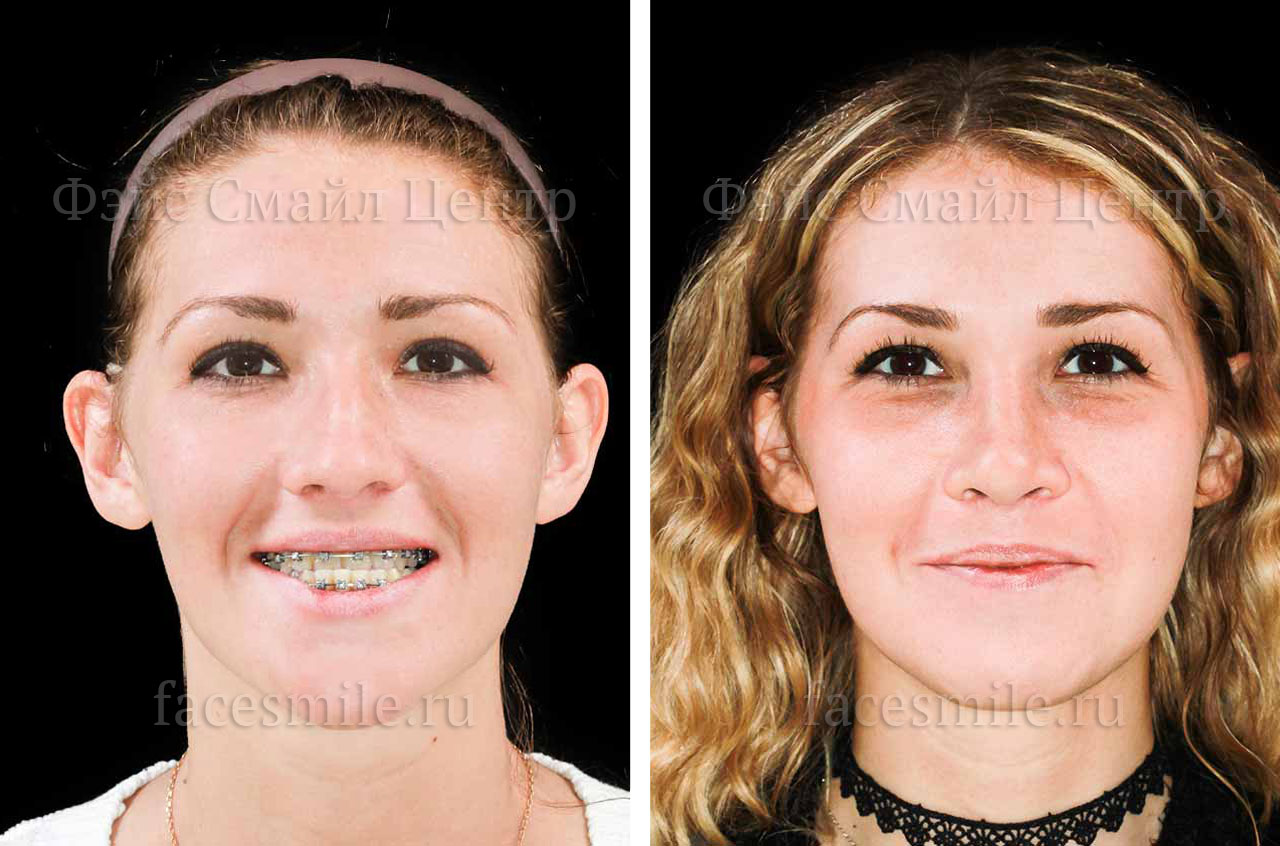 Коррекция прикуса за счет остеотомии при ортогнатической операции фото пациента до и после в анфас с улыбкой
