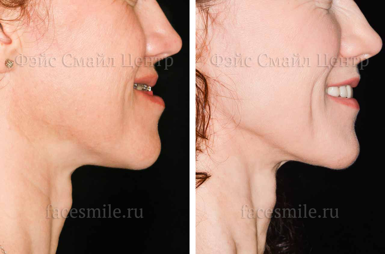Коррекция прикуса, фото пациента До и После в профиль с улыбкой