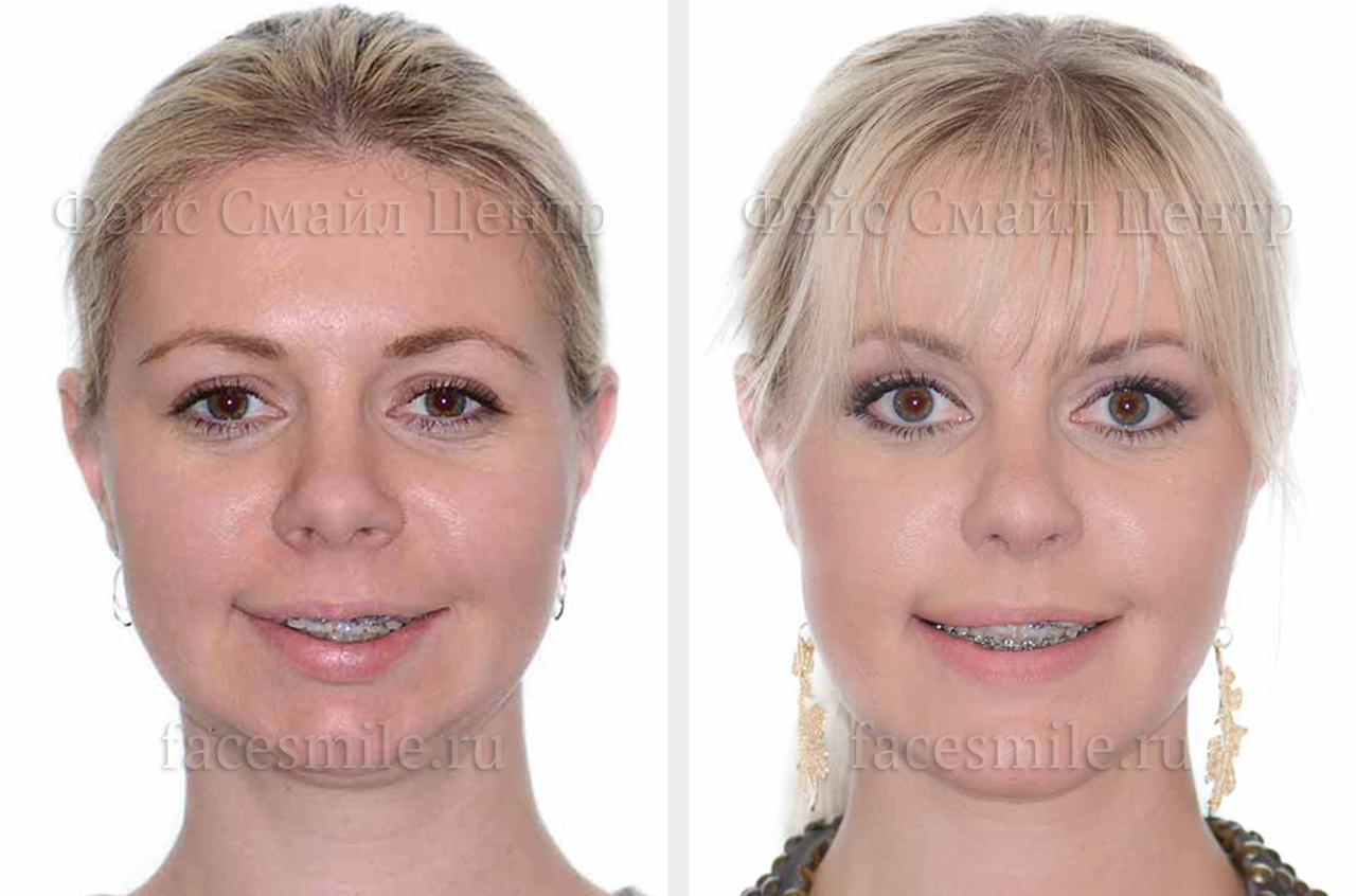 Коррекция прикуса, фото пациента До и После в профиль без улыбки