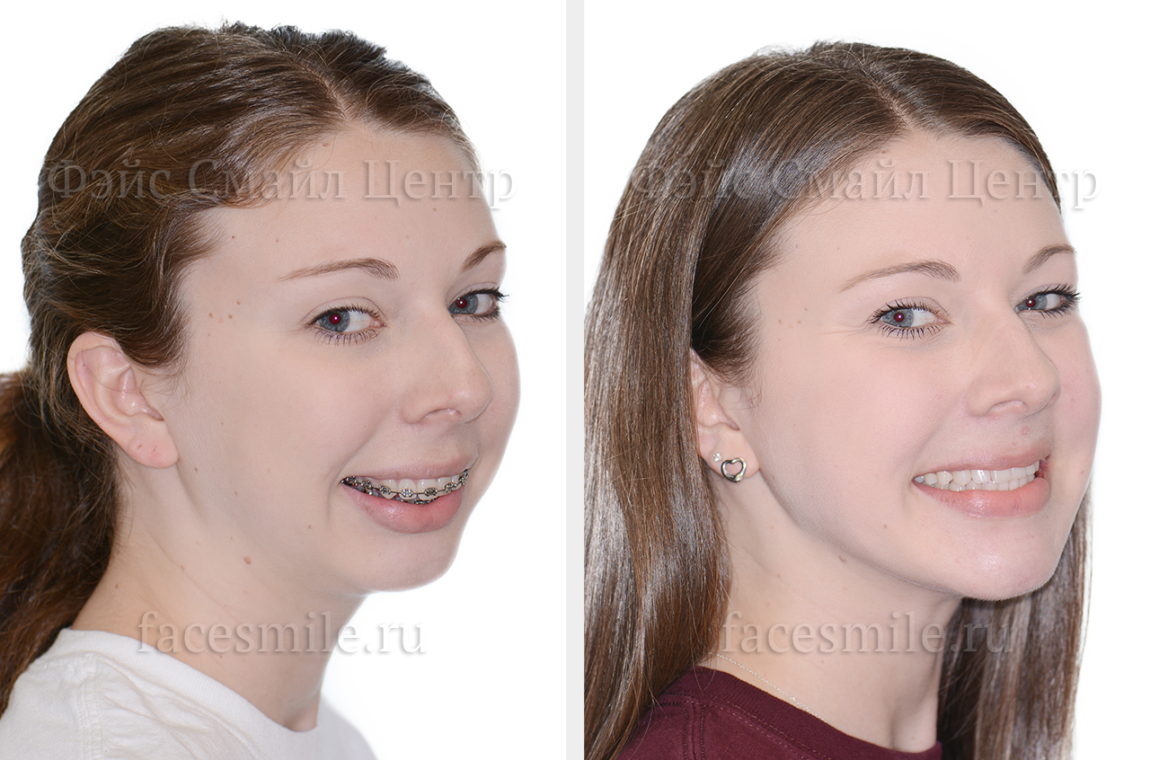 Коррекция скелетного открытого прикуса, фото пациента До и После в профиль без улыбки