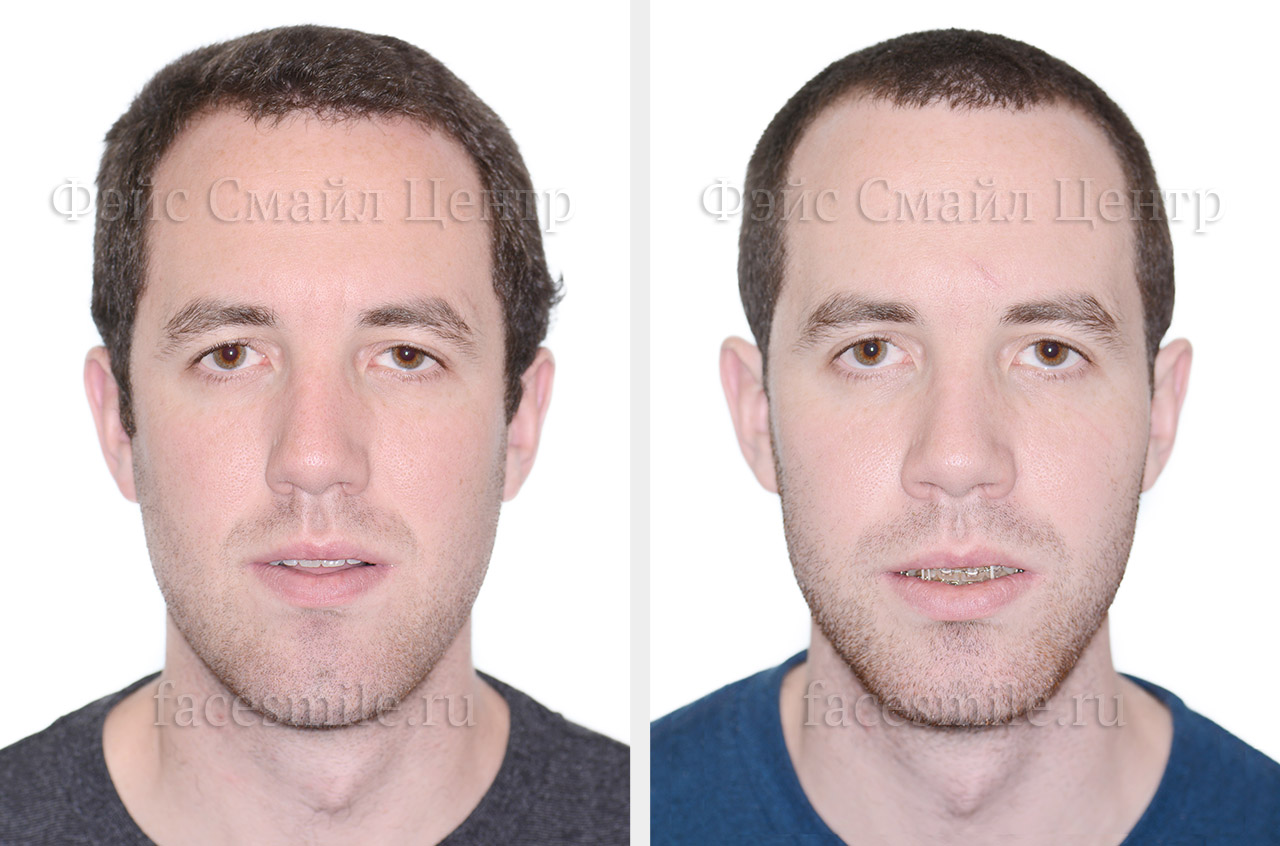 Коррекция скелетного открытого прикуса, фото пациента До и После в анфас без улыбки