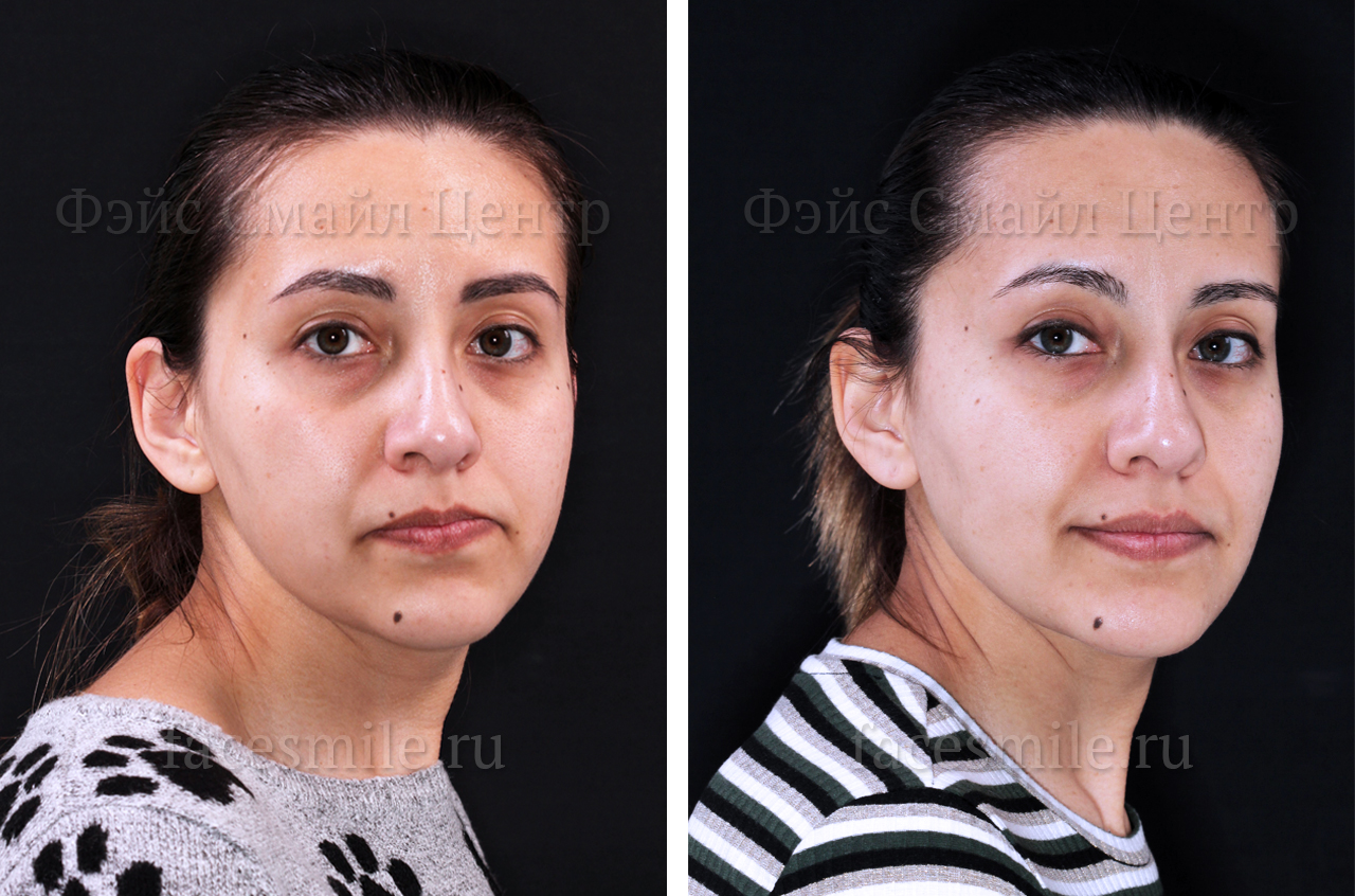 Коррекция скелетного открытого прикуса, фото пациента До и После в анфас с улыбкой