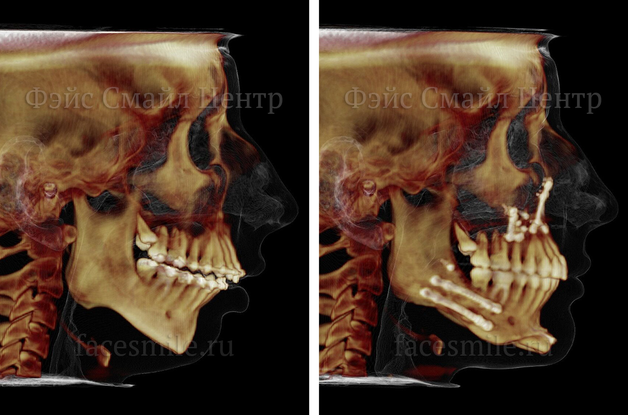 Коррекция скелетного открытого прикуса, фото пациента До и После в анфас с улыбкой