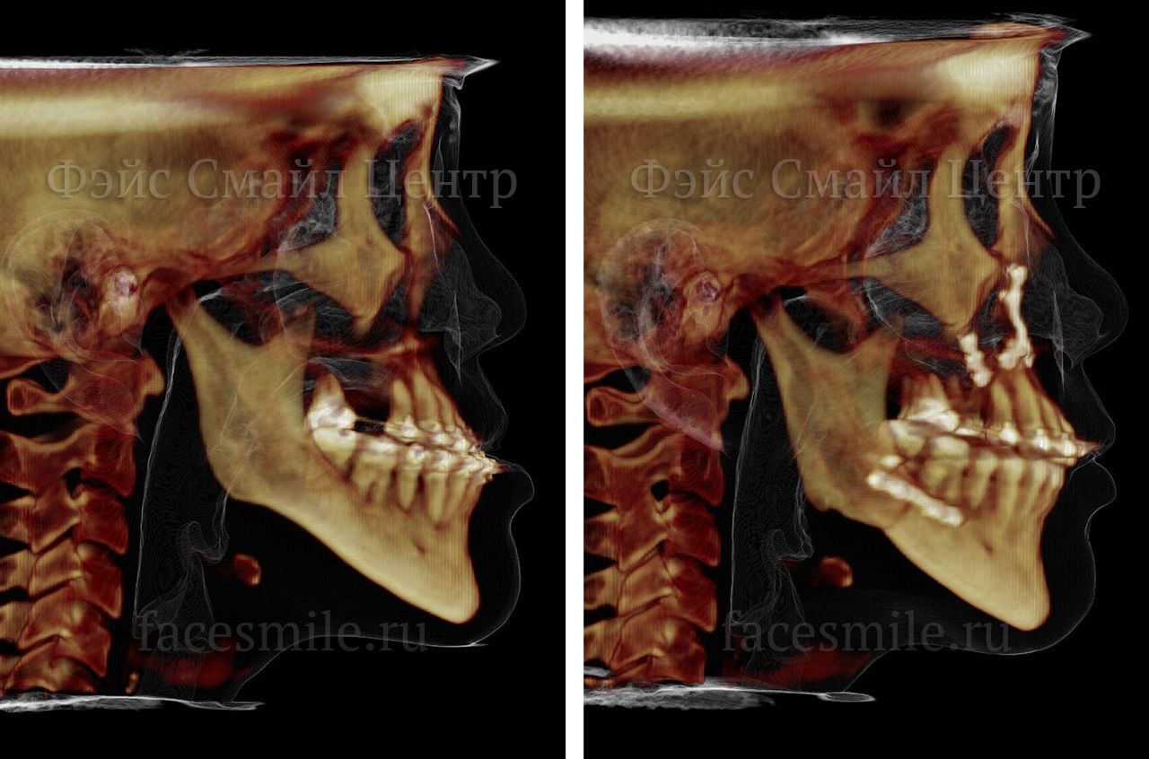 Коррекция скелетного открытого прикуса, фото До и После в 3/4 с улыбкой