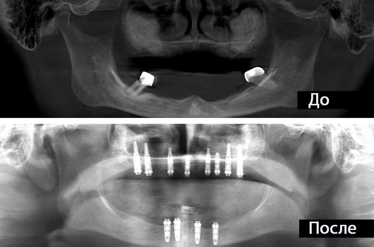 Имплантация все на четырех рентгеновские снимки до и после