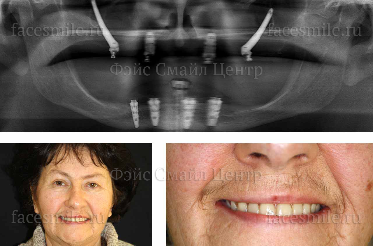 Имплантация зубов по системе Зигома
