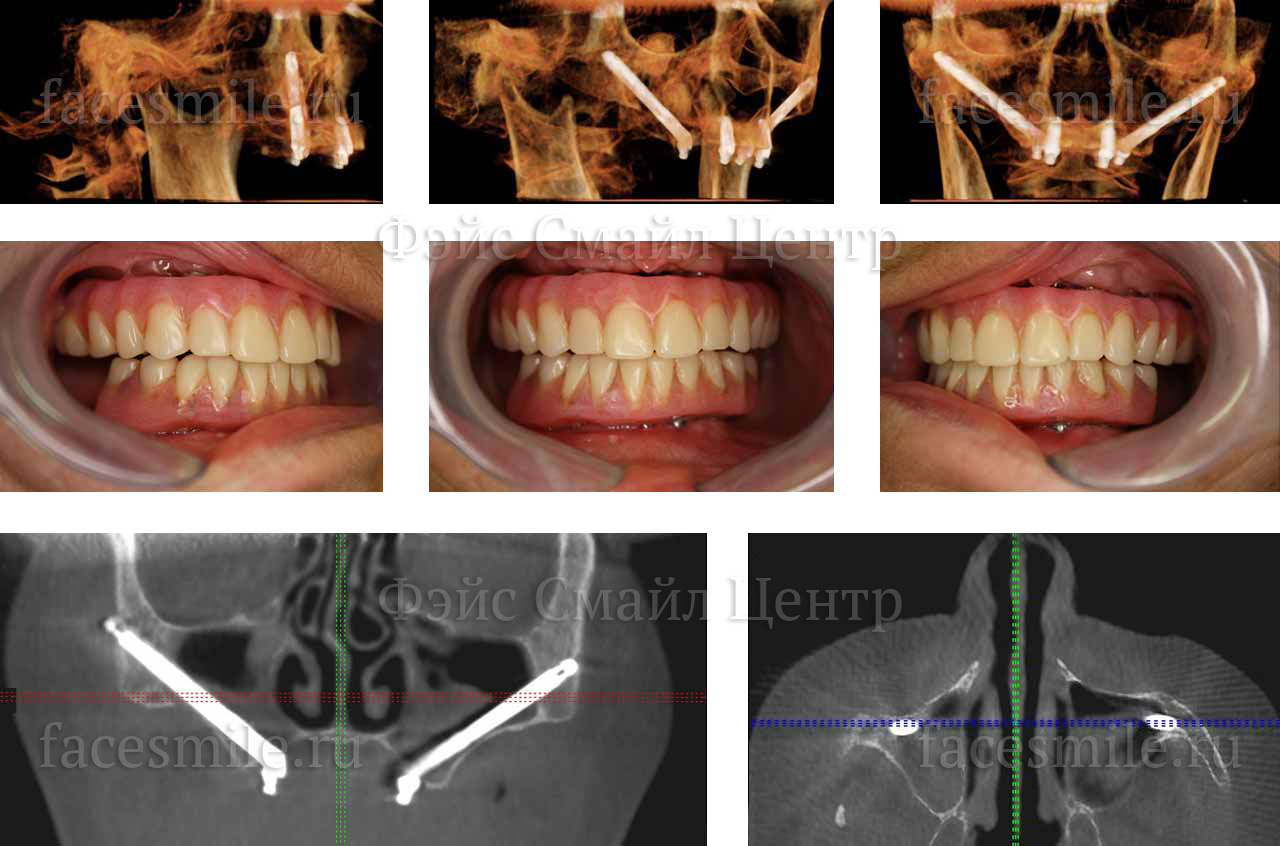Имплантация зубов по системе Зигома до и после