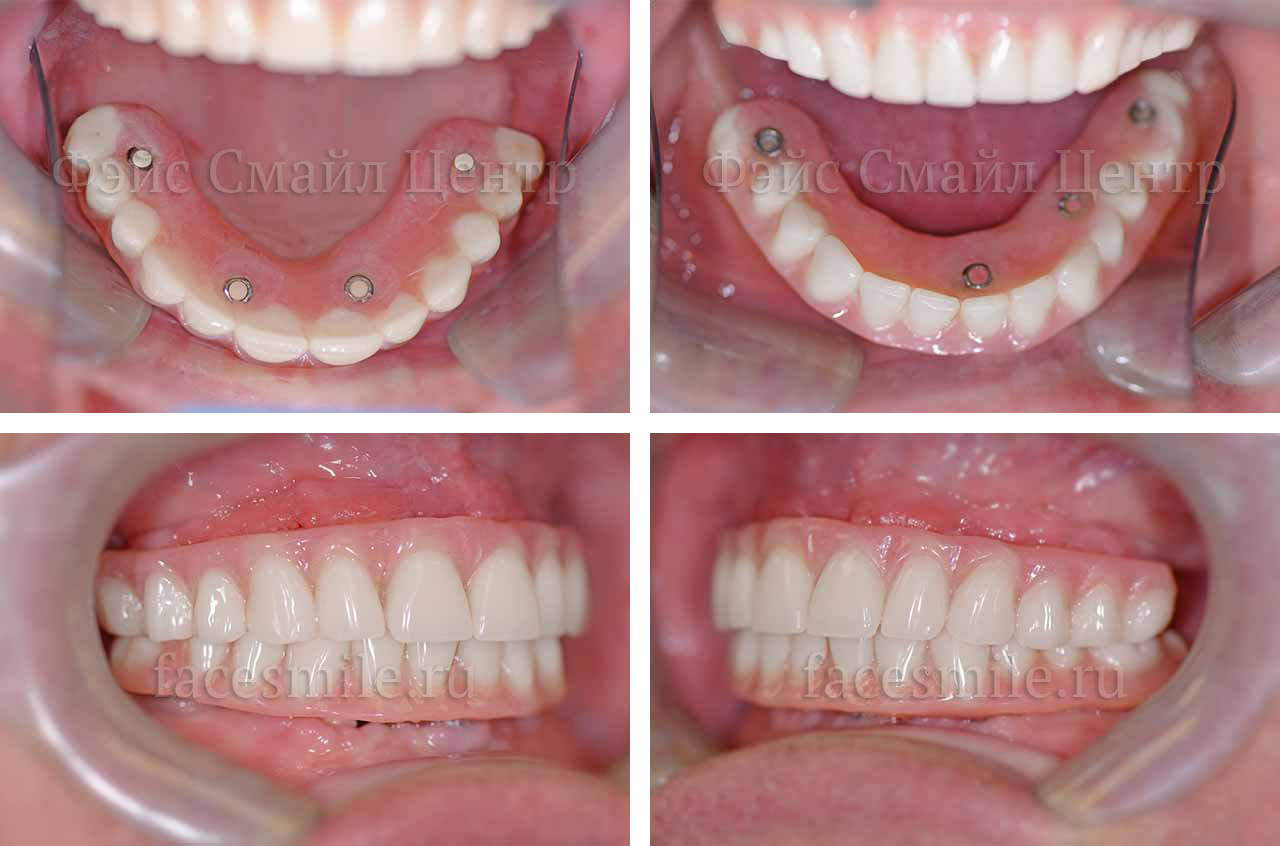 Временные зубные протезы после имплантации по методике все на четырех в клинике Фэйс Смайл центр